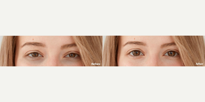 Upneeq before and after photo