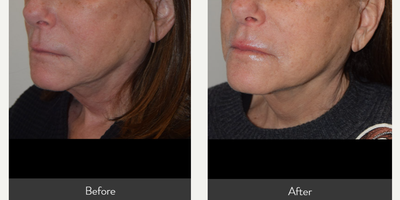 AccuTite before and after photo