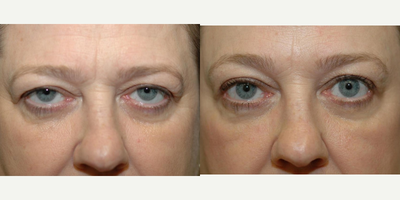 Brow Lift before and after photo