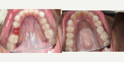Dental Implants before and after photo