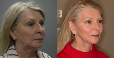 Facelift before and after photo