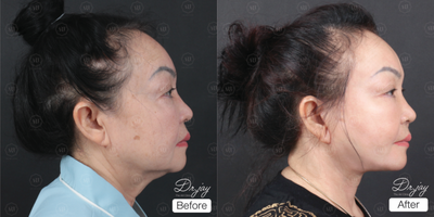 Facelift before and after photo