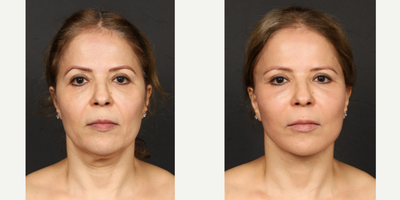 Facial Fat Transfer before and after photo