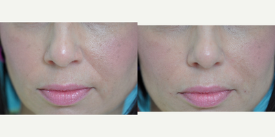 Juvederm before and after photo