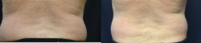 SculpSure before and after photo