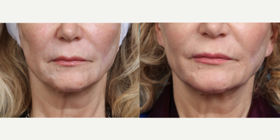 CO2 Laser before and after photo