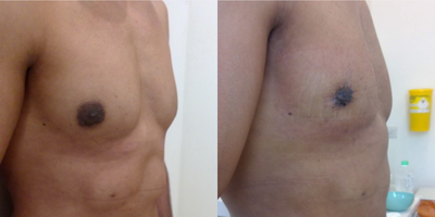 Gynecomastia Surgery before and after photo