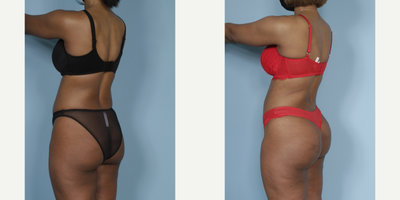 Brazilian Butt Lift before and after photo