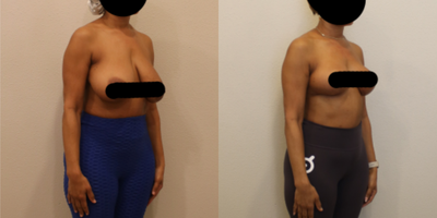 Breast Lift before and after photo