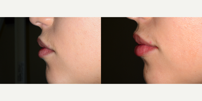 Dermal Fillers before and after photo