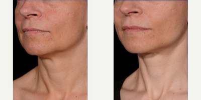 Mini Facelift before and after photo