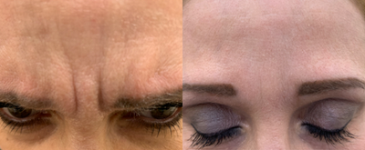 Botox before and after photo