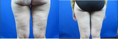 Cellulaze before and after photo
