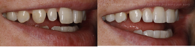 Dental Bonding before and after photo