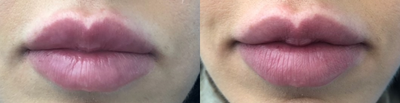 Lip Fillers before and after photo