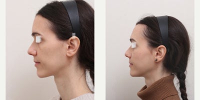 Nonsurgical Facelift before and after photo