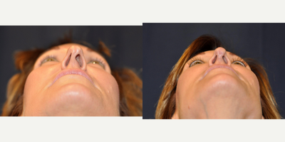 Rhinoplasty before and after photo