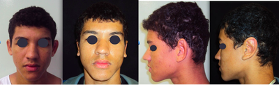 Ear Surgery before and after photo