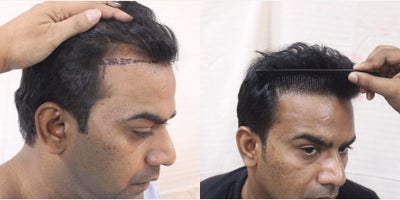 Hair Transplant before and after photo