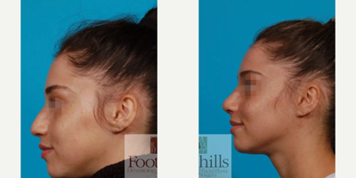 Rhinoplasty before and after photo