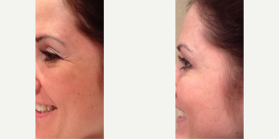 Botox before and after photo