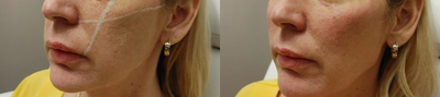 Dermal Fillers before and after photo