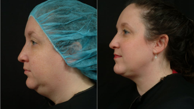 Smart Lipo before and after photo
