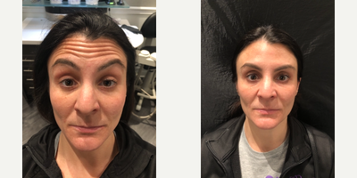 Botox before and after photo