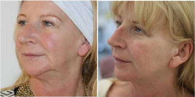 Dermal Fillers before and after photo