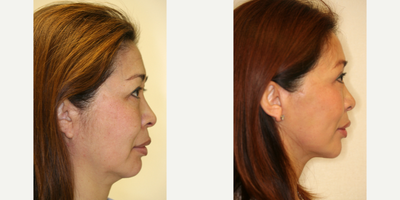 Facelift before and after photo