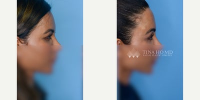 Brow Lift before and after photo