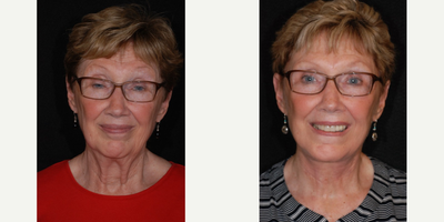 Facelift before and after photo