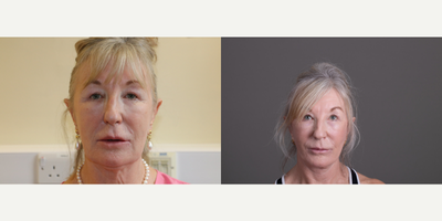Facelift before and after photo