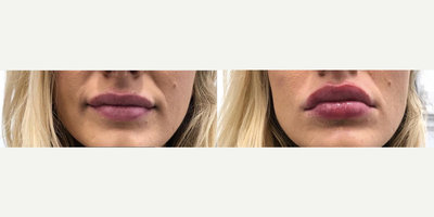 Lip Fillers before and after photo