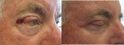Mohs Surgery before and after photo