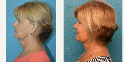 Neck Lift before and after photo