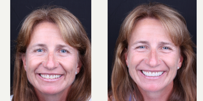 Porcelain Veneers before and after photo