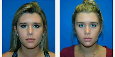 Rhinoplasty before and after photo