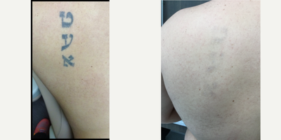 Tattoo Removal before and after photo