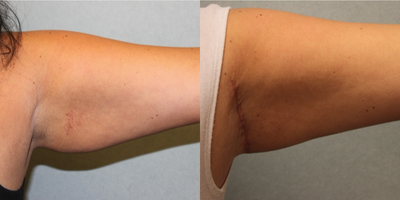 Arm Lift before and after photo