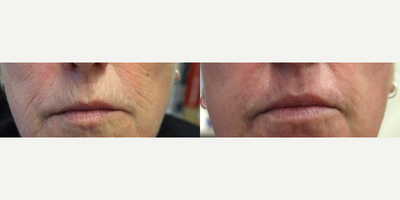 Laser Resurfacing before and after photo