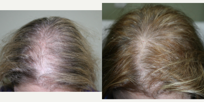 PRP for Hair Loss before and after photo