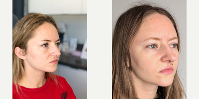 Radiesse before and after photo