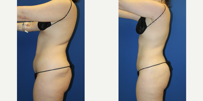 Vaser Liposuction before and after photo