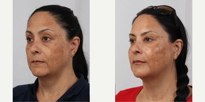 Botox before and after photo