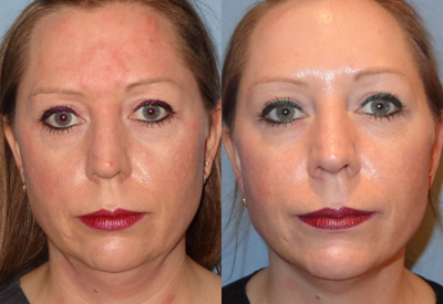 Kybella before and after photo