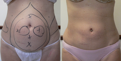 Laser Liposuction before and after photo