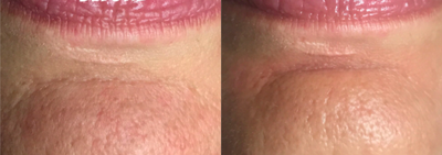 Microneedling before and after photo