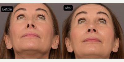 Revision Rhinoplasty before and after photo