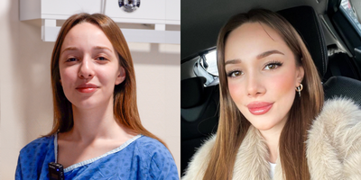 Rhinoplasty before and after photo